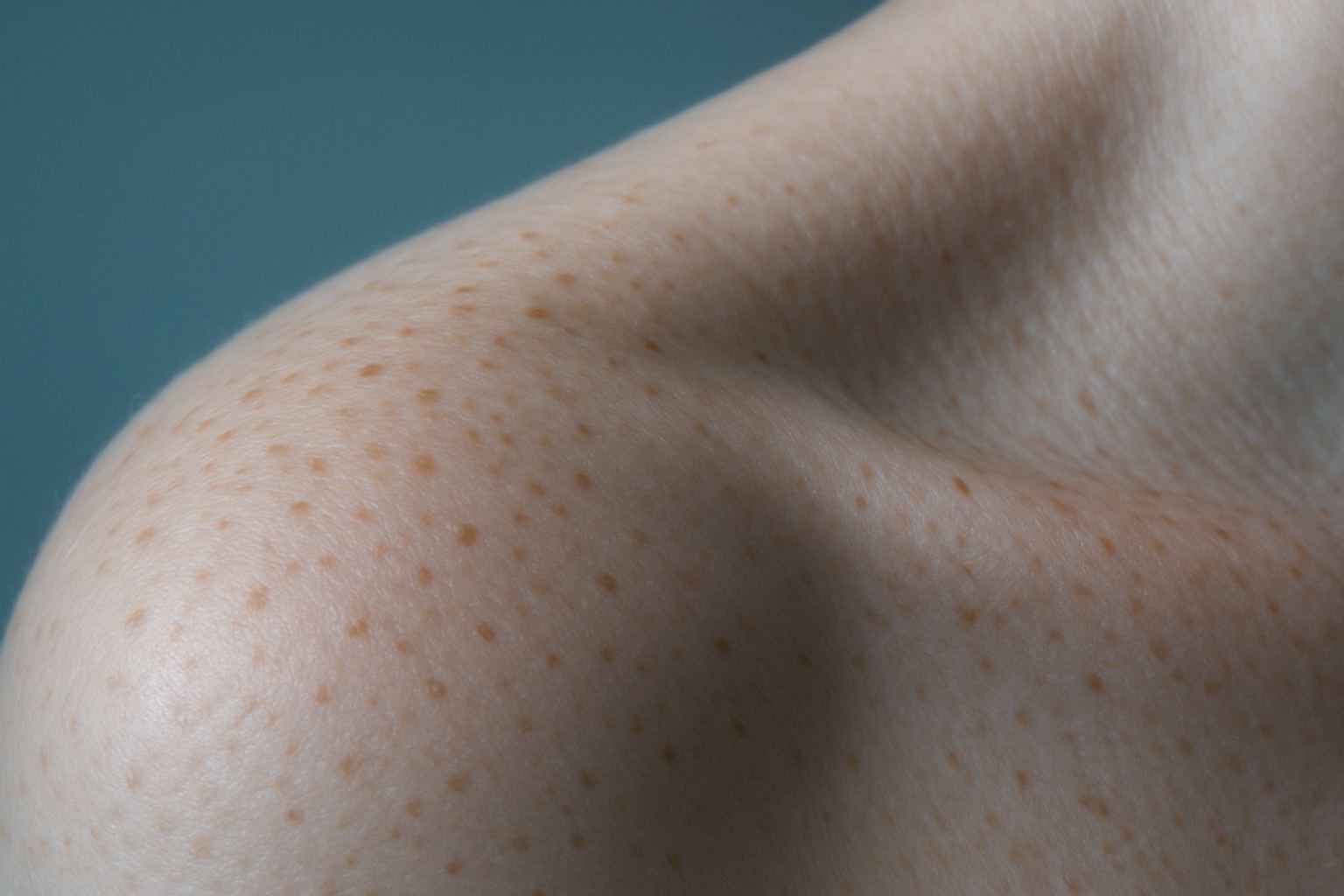 Pigmentation and melasma, editorial image